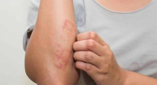 Mato Grosso lidera casos de hanseníase e ALMT lança frente parlamentar para combater doença