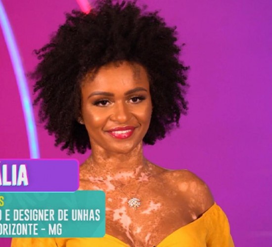 O que é vitiligo? Entenda a doença de Natália Deodato, participante do BBB 22