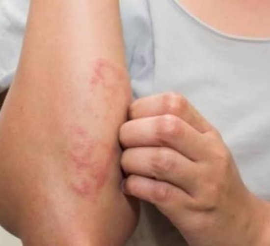 Mato Grosso lidera casos de hanseníase e ALMT lança frente parlamentar para combater doença