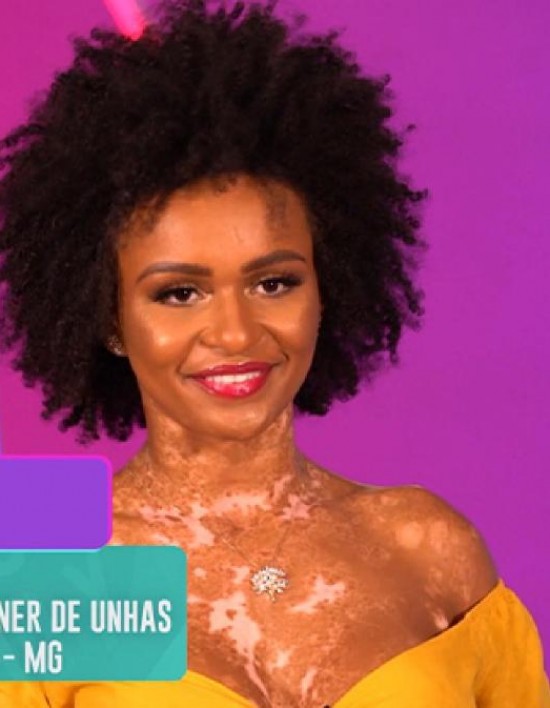O que é vitiligo? Entenda a doença de Natália Deodato, participante do BBB 22